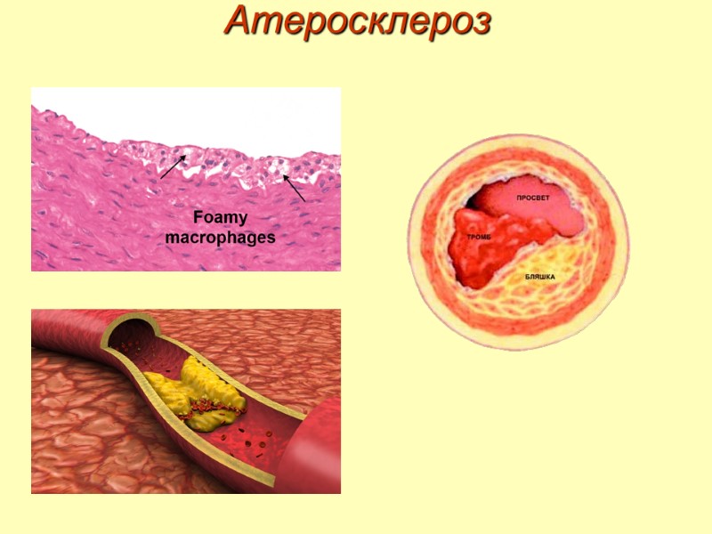 Атеросклероз